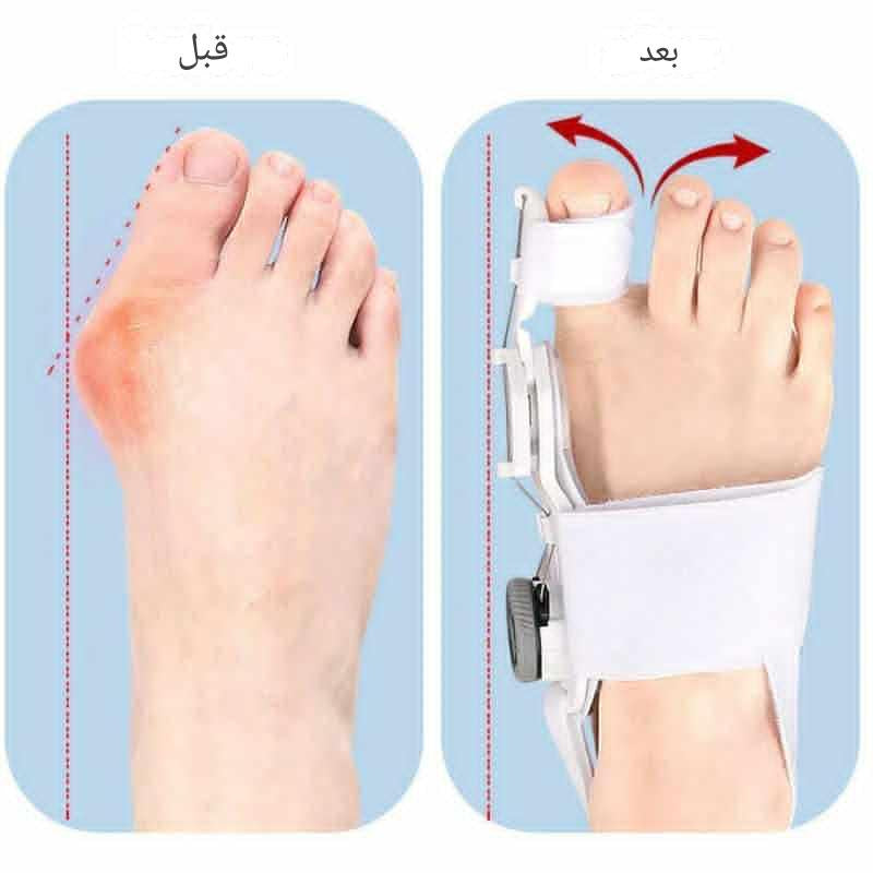 جهاز لتصحيح اعوجاج إصبع القدم الكبير